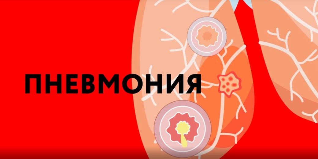 «Это должен знать каждый»: пневмония