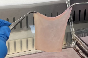 Пересадка биоинженерной кожи из стволовых клеток пациента (Австралия)