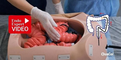 Ведущий специалист ОМО по колопроктологии подготовила видеопособие «Важная роль медицинской сестры при колоноскопии»