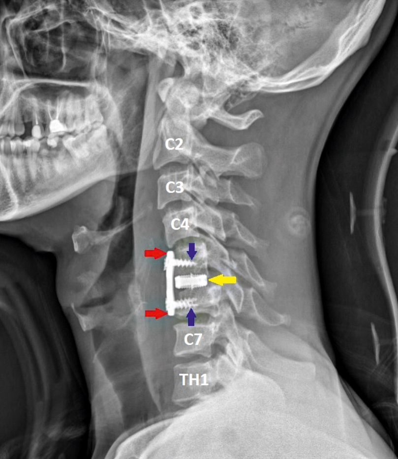 После операции_боковая проекция.jpg